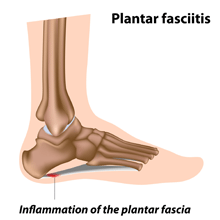 plantar fasciitis