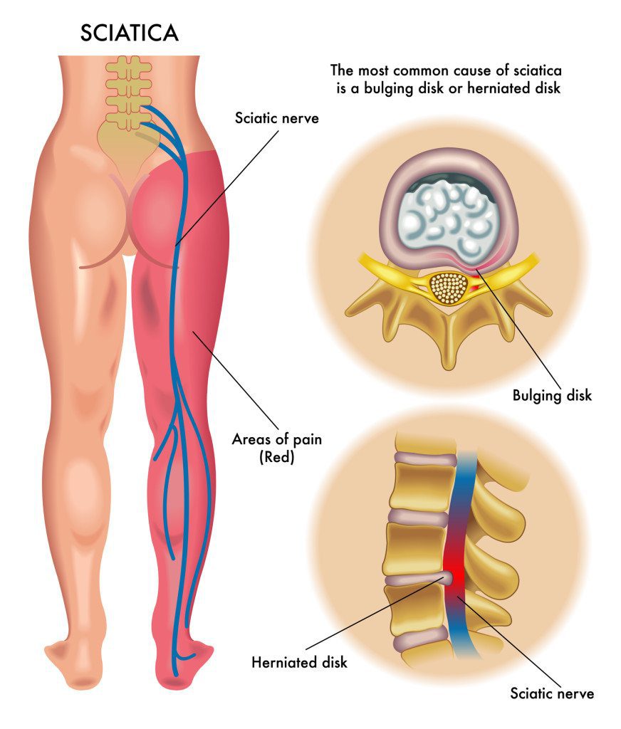 Acupuncture Chicago, Pinched Nerve Pain Relief